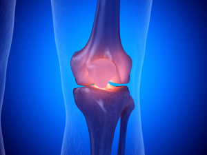 Artroza koljena: Simptomi, uzroci i fizioterapijski tretmani